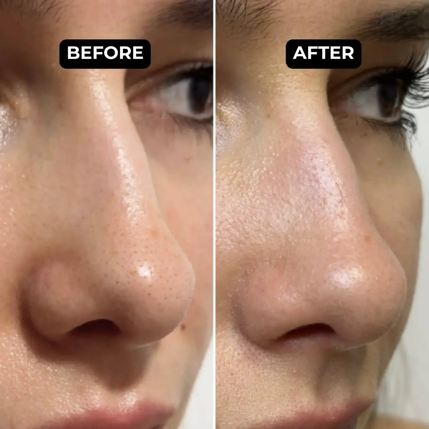 MILSOME™ Nose Patches